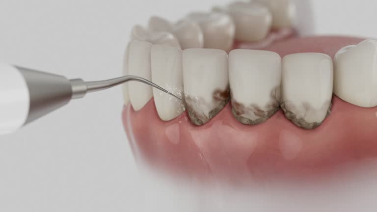 Trusted Dental Crowns And Bridges service in University City, MO - Dentist Open Now